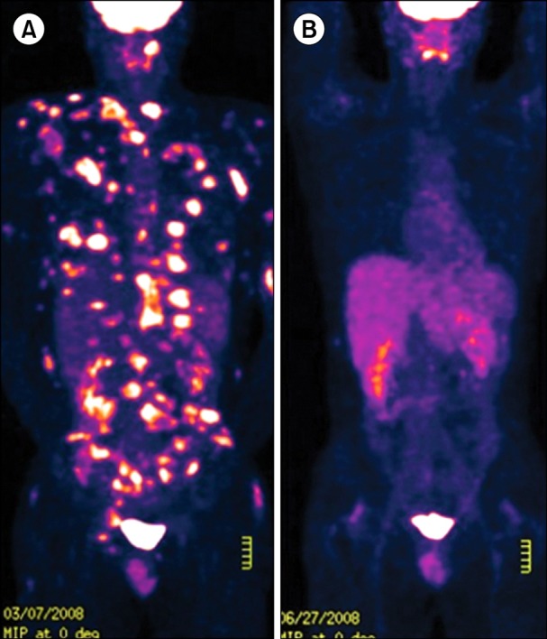 Cyclosporine A treatment for relapsed subcutaneous panniculitis-like T-cell lymphoma: a case with long-term follow-up.