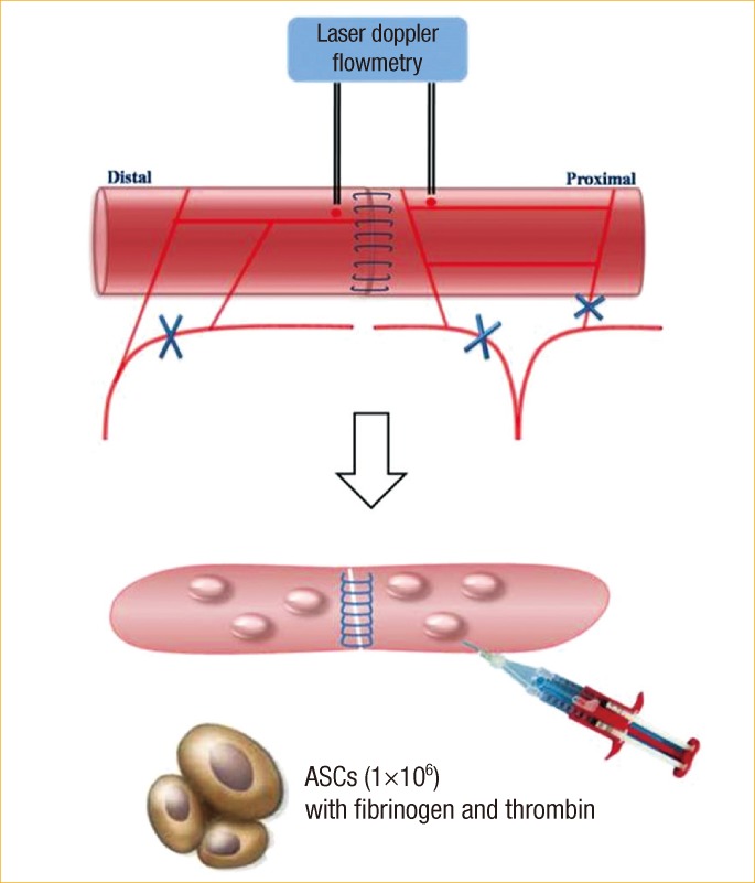 Adipose-tissue-derived Stem Cells Enhance the Healing of Ischemic Colonic Anastomoses: An Experimental Study in Rats.