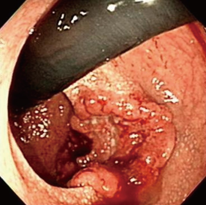 A case of rectal cancer in a patient with neurofibromatosis type 1.