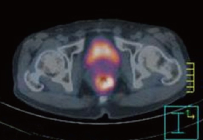 A case of rectal cancer in a patient with neurofibromatosis type 1.