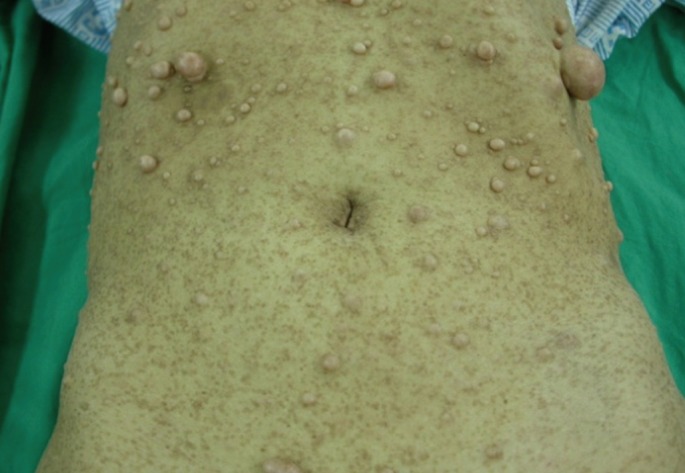 A case of rectal cancer in a patient with neurofibromatosis type 1.