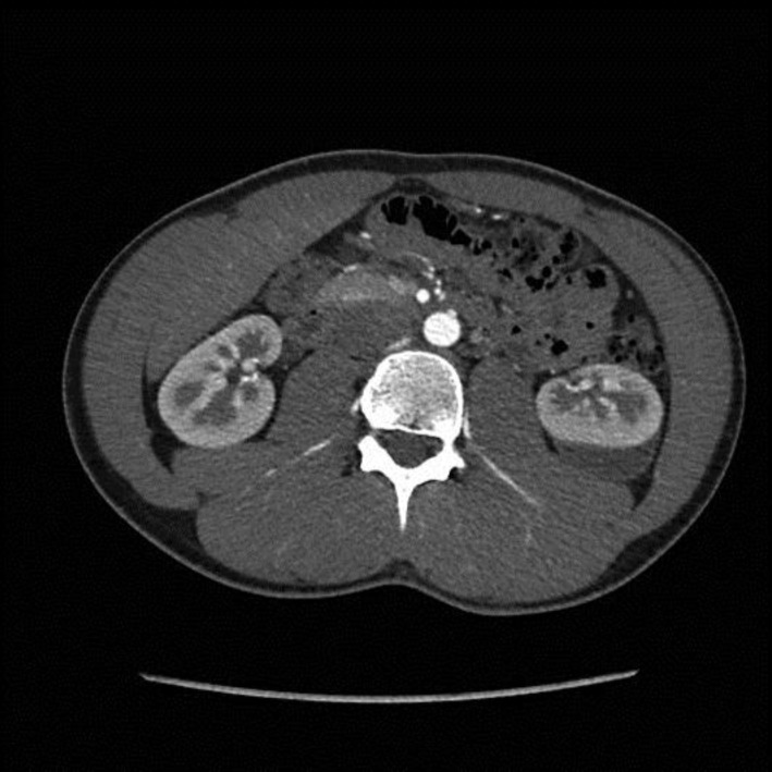 Perinephric haematoma causing refractory hypertension in a 17-year-old male.