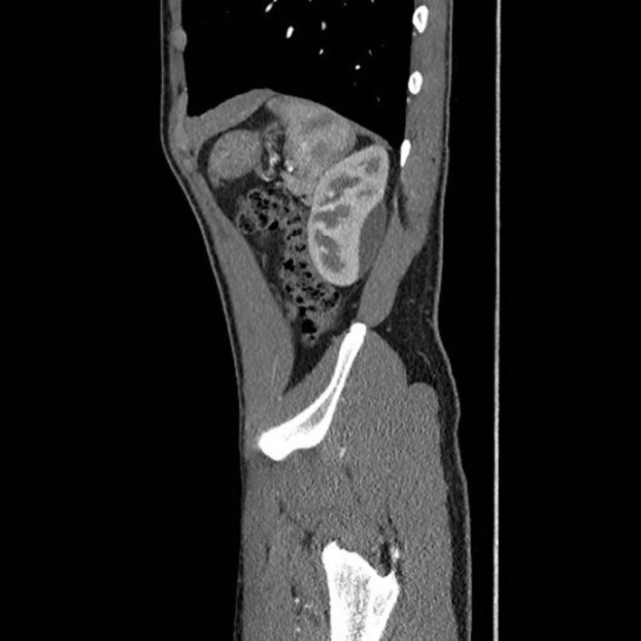Perinephric haematoma causing refractory hypertension in a 17-year-old male.