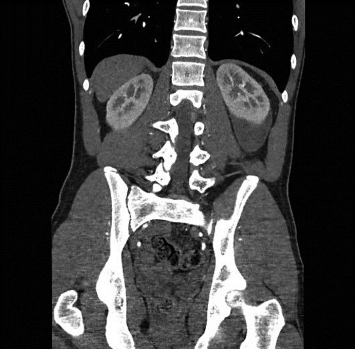Perinephric haematoma causing refractory hypertension in a 17-year-old male.