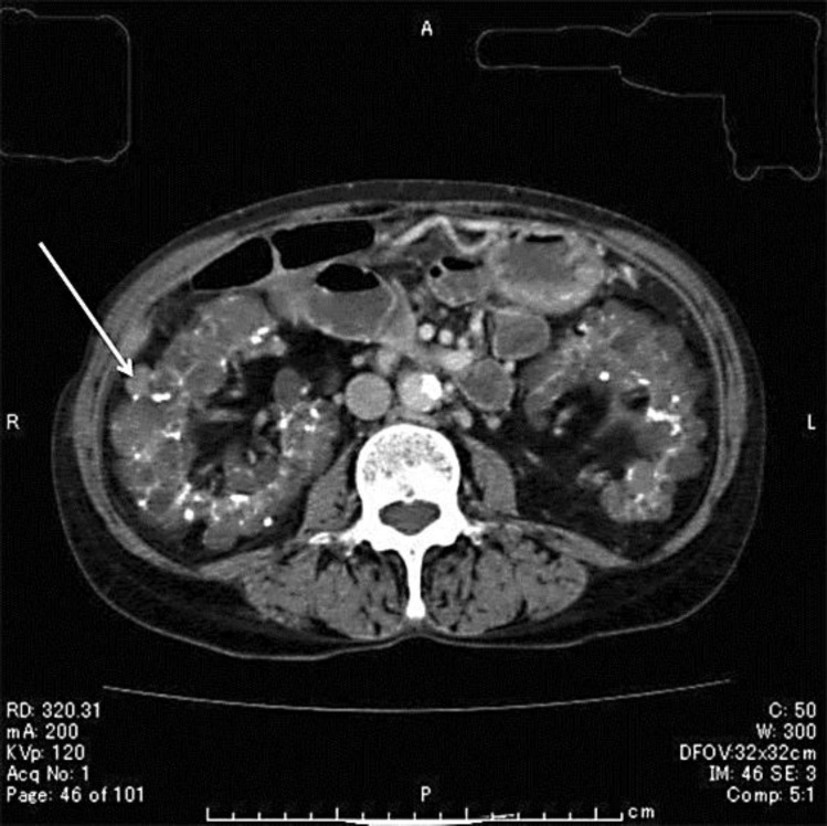 Campylobacter bacteremia in hemodialysis patients by eating raw meat - the importance of sanitary education.