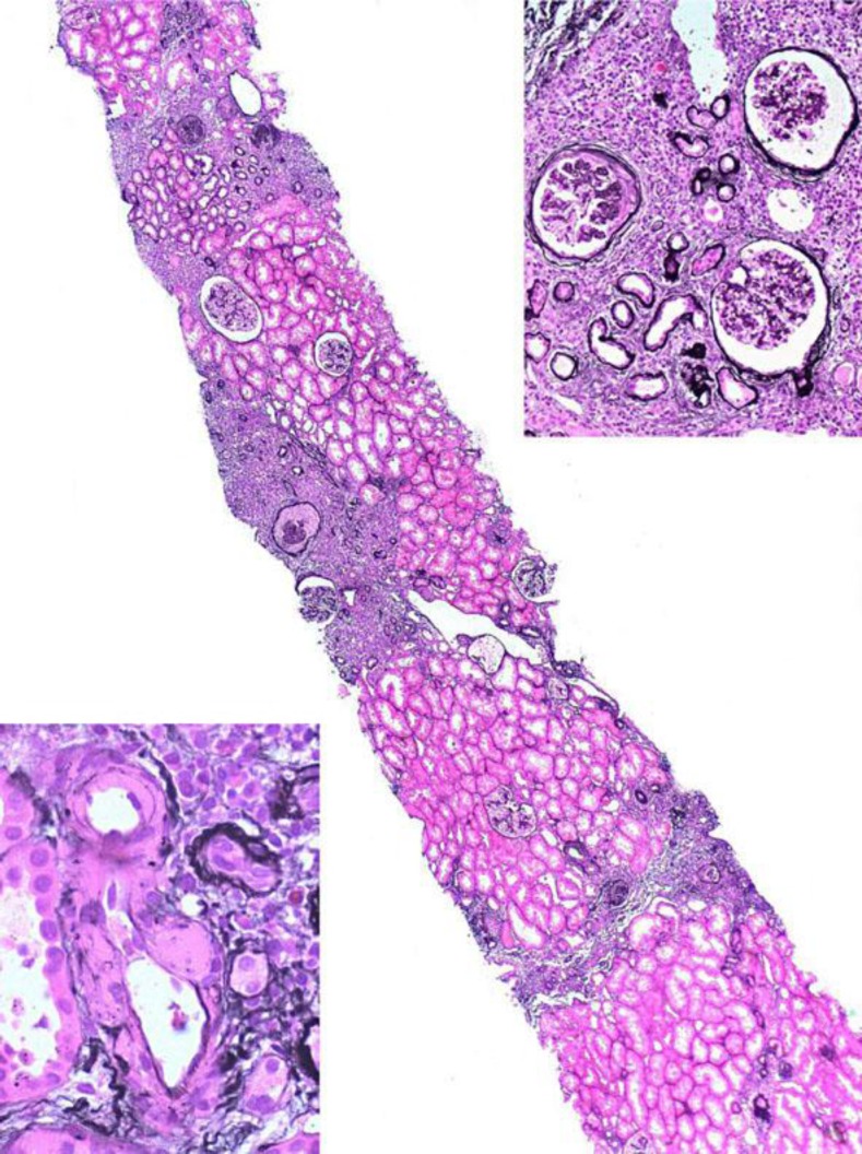 Renal cell carcinoma in the allograft: what is the role of polyomavirus?
