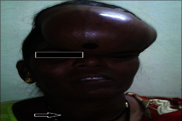 Follicular thyroid carcinoma presenting as massive skull metastasis: a rare case report and literature review.
