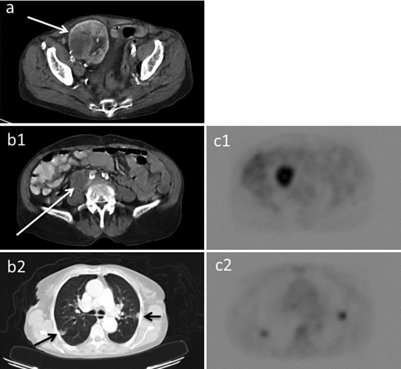Renal cell carcinoma in the allograft: what is the role of polyomavirus?