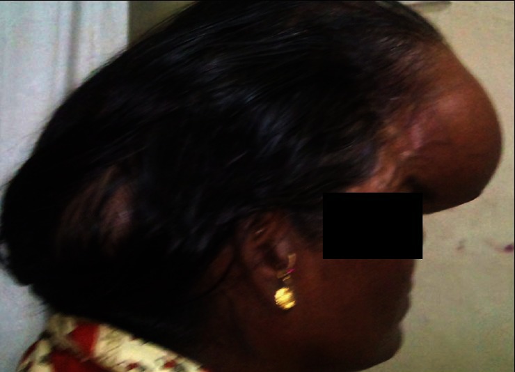 Follicular thyroid carcinoma presenting as massive skull metastasis: a rare case report and literature review.