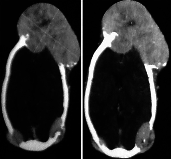 Follicular thyroid carcinoma presenting as massive skull metastasis: a rare case report and literature review.