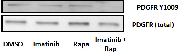 Cooperative benefit for the combination of rapamycin and imatinib in tuberous sclerosis complex neoplasia.