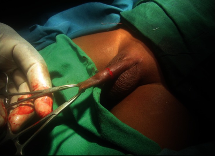Dorsal slit-sleeve technique for male circumcision.
