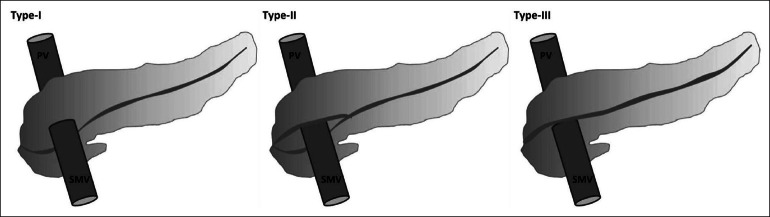Portal annular pancreas: an under-reported pancreatic anomaly.