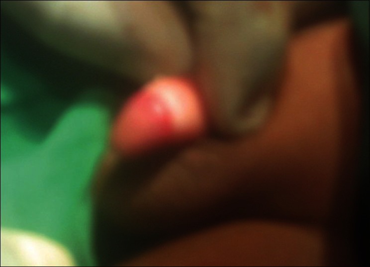 Dorsal slit-sleeve technique for male circumcision.