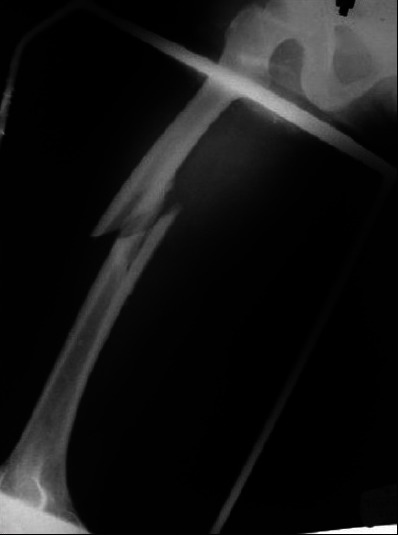 Management of maternofetal emergency in shock with fracture of femur.