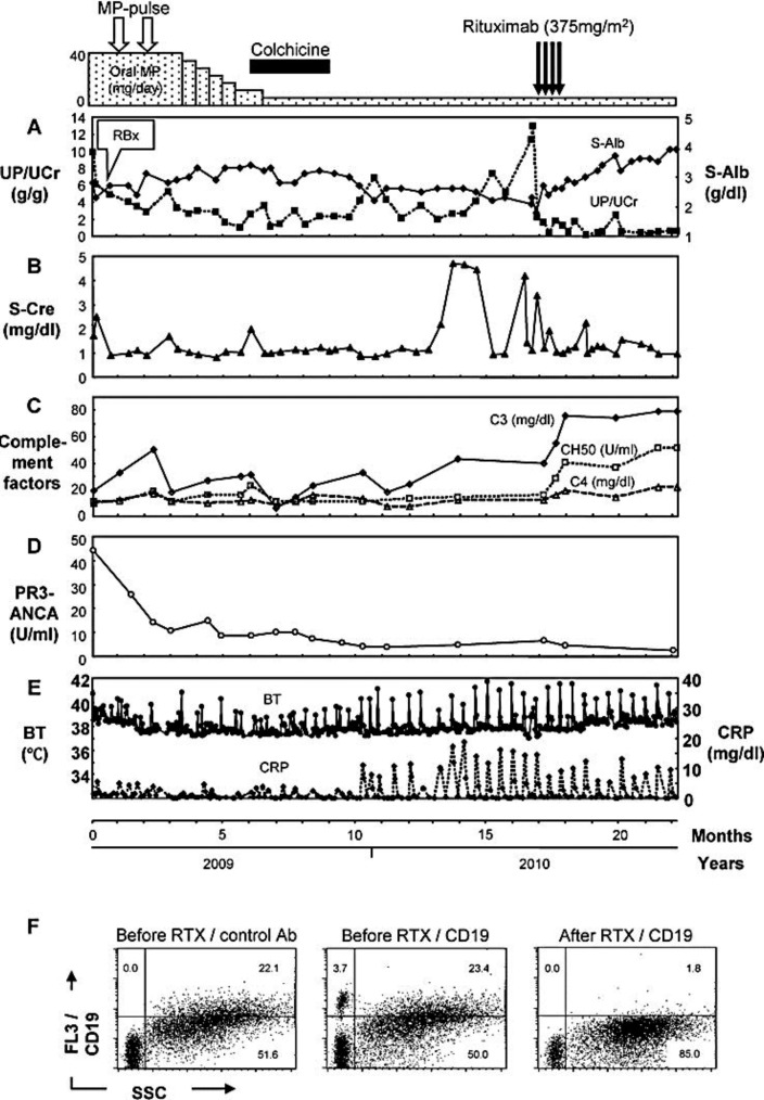 Rituximab Treatment for PR3-ANCA-Positive Membranoproliferative Glomerulonephritis Associated with Adult-Onset Periodic Fever Syndrome.