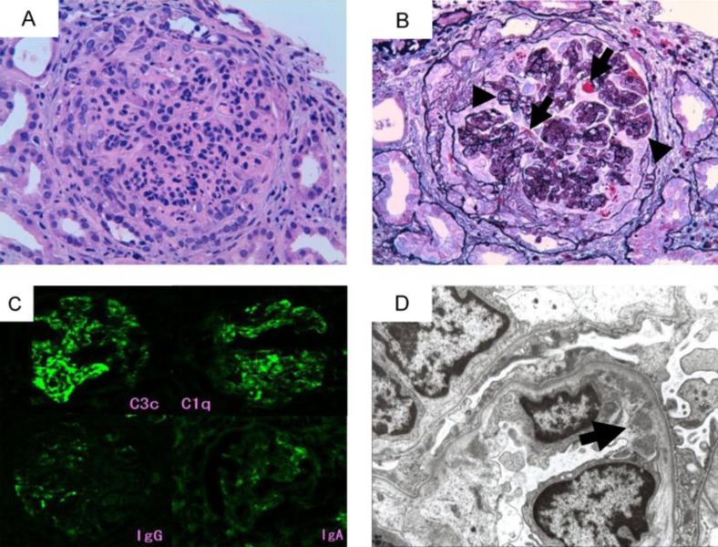 Rituximab Treatment for PR3-ANCA-Positive Membranoproliferative Glomerulonephritis Associated with Adult-Onset Periodic Fever Syndrome.