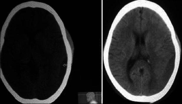 Management of chronic subdural haematoma in a case of idiopathic thrombocytopenic purpura.