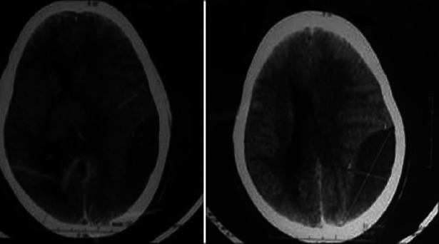 Management of chronic subdural haematoma in a case of idiopathic thrombocytopenic purpura.