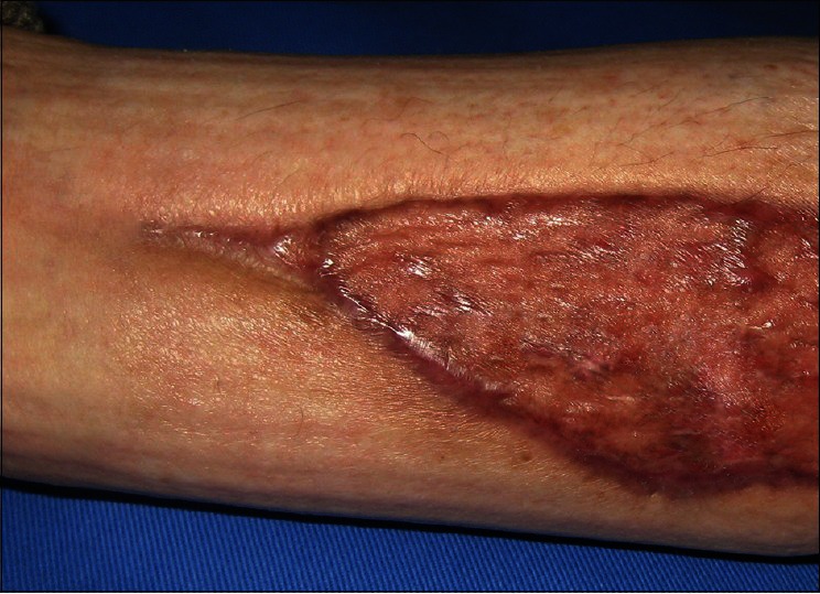 "The Dendritic Bonding Technique": A Newly-devised Technique for the Fixation of Mesh Skin Graft.