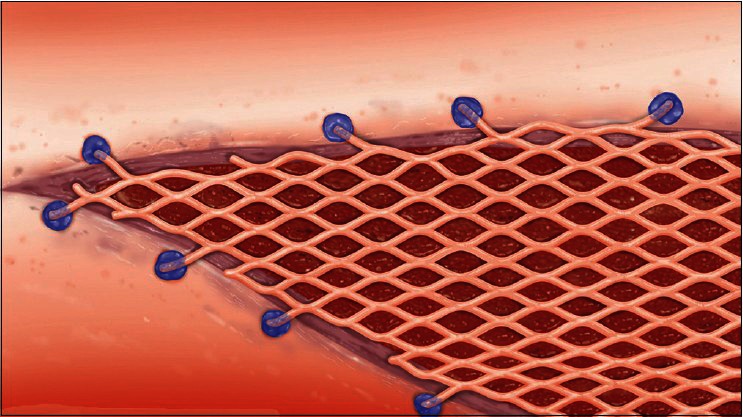 "The Dendritic Bonding Technique": A Newly-devised Technique for the Fixation of Mesh Skin Graft.