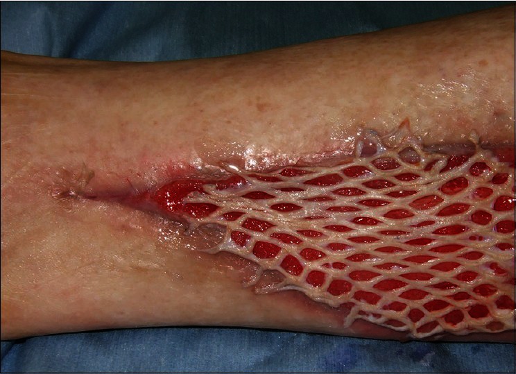 "The Dendritic Bonding Technique": A Newly-devised Technique for the Fixation of Mesh Skin Graft.