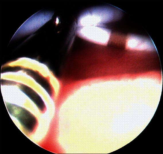 "Bilateral Double J Stent Removal: The way to do it!".