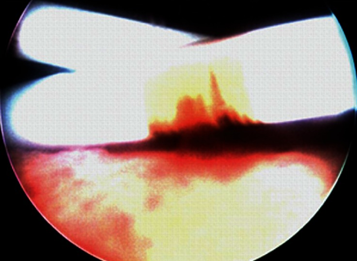 "Bilateral Double J Stent Removal: The way to do it!".