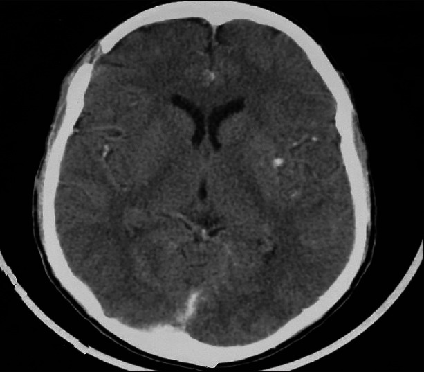 Spontaneous epidural haematoma in sickle cell anaemia: case report and literature review.