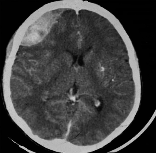 Spontaneous epidural haematoma in sickle cell anaemia: case report and literature review.