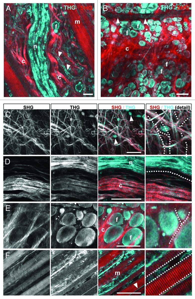 Intravital third harmonic generation microscopy of collective melanoma cell invasion: Principles of interface guidance and microvesicle dynamics.