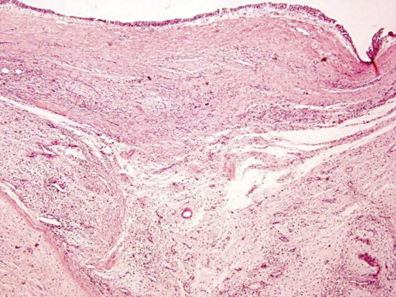 Low-grade fibromyxoid sarcoma of the renal pelvis: first report.