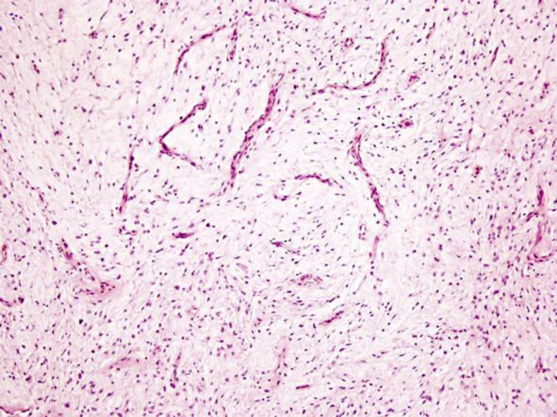 Low-grade fibromyxoid sarcoma of the renal pelvis: first report.