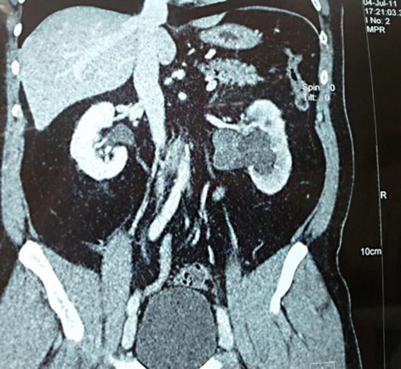 Low-grade fibromyxoid sarcoma of the renal pelvis: first report.