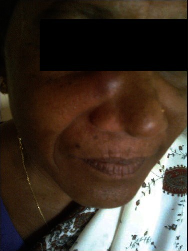 A rare case of spindle cell lipoma of nose.