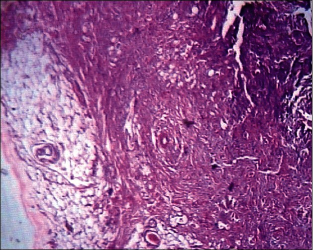 A rare case of spindle cell lipoma of nose.