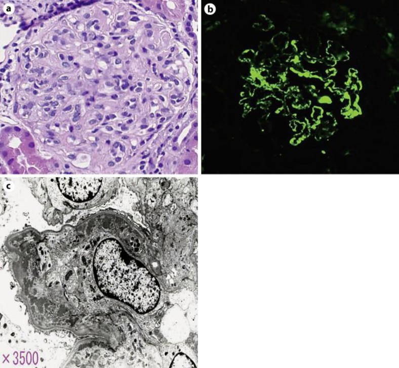 A case of diffuse endocapillary proliferative glomerulonephritis associated with polymyalgia rheumatica.
