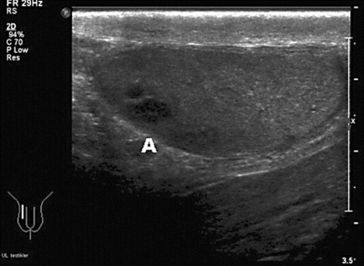Seminoma in the testis presenting as hemospermia.