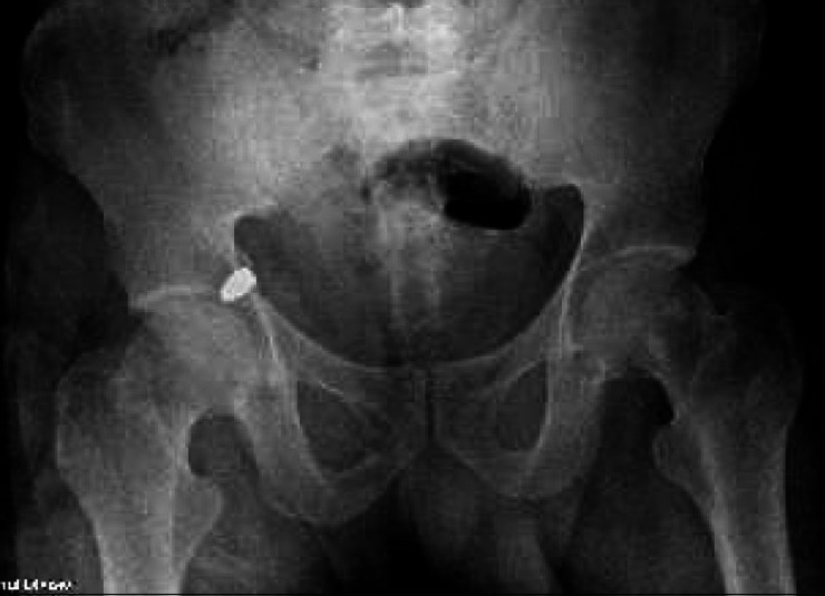 Arthroscopic bullet removal from the acetabulum (hip joint).