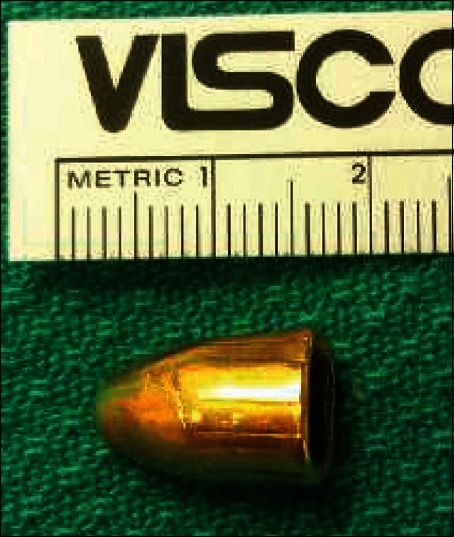 Arthroscopic bullet removal from the acetabulum (hip joint).