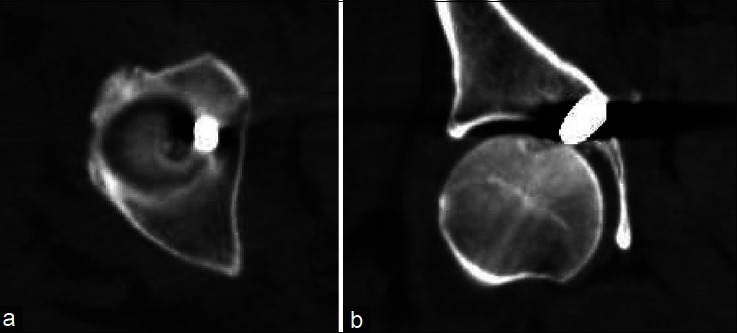 Arthroscopic bullet removal from the acetabulum (hip joint).