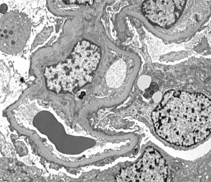 Seasonal relapsing minimal change disease: a novel strategy for avoiding long-term immunosuppression.