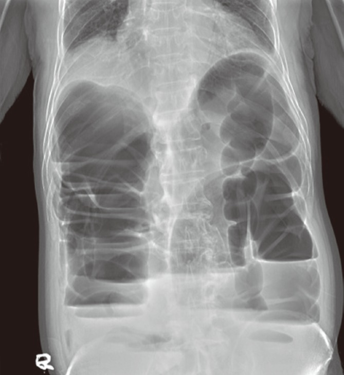 A case of a mucinous adenocarcinoma arising from a rectal diverticulum.