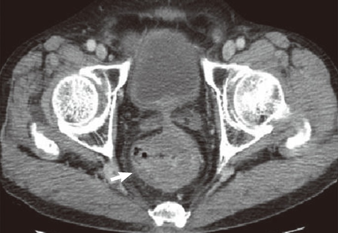 A case of a mucinous adenocarcinoma arising from a rectal diverticulum.