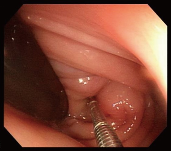 A case of a mucinous adenocarcinoma arising from a rectal diverticulum.