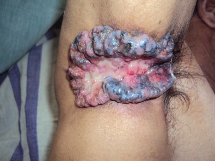 Neglected Basal cell carcinoma in axilla.