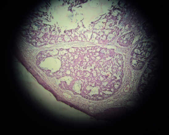 Neglected Basal cell carcinoma in axilla.