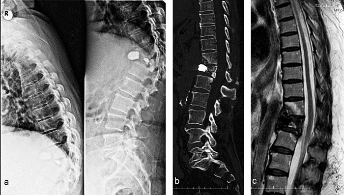 Percutaneous minimally invasive versus open spine surgery in the treatment of fractures of the thoracolumbar junction: a comparative effectiveness review.