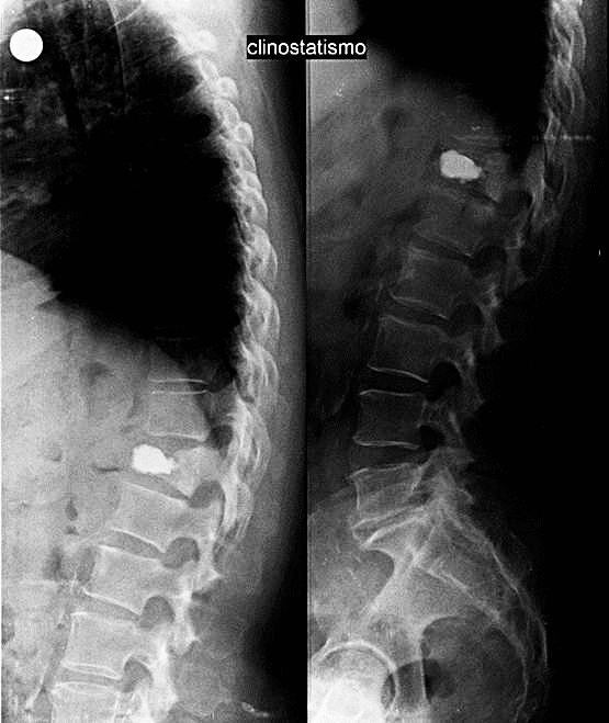 Percutaneous minimally invasive versus open spine surgery in the treatment of fractures of the thoracolumbar junction: a comparative effectiveness review.