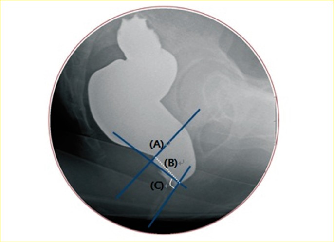 An analysis of factors associated with increased perineal descent in women.